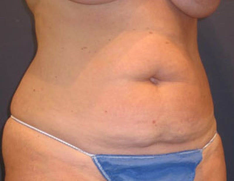 Tummy Tuck Before & After