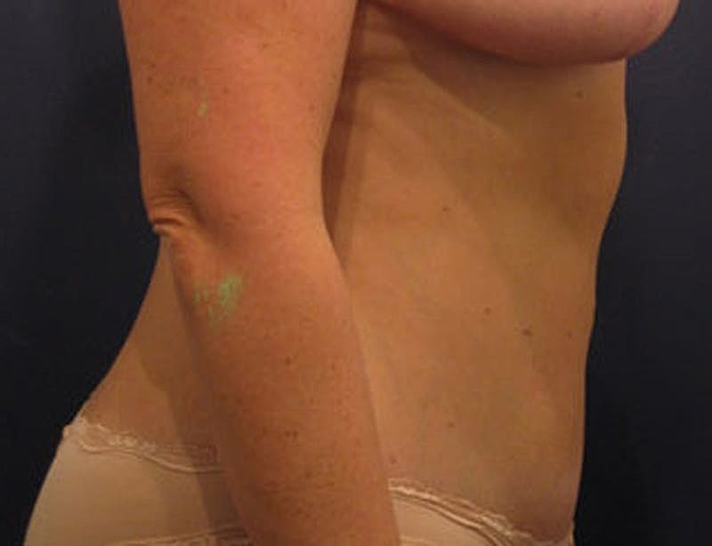 Tummy Tuck Before & After