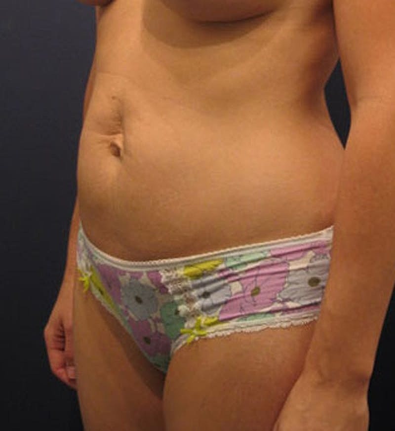 Tummy Tuck Before & After