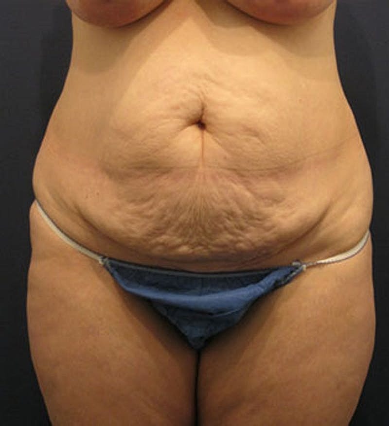 Tummy Tuck Before & After