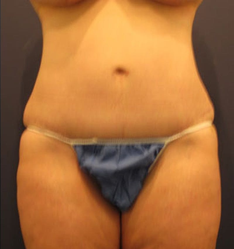 Tummy Tuck Before & After