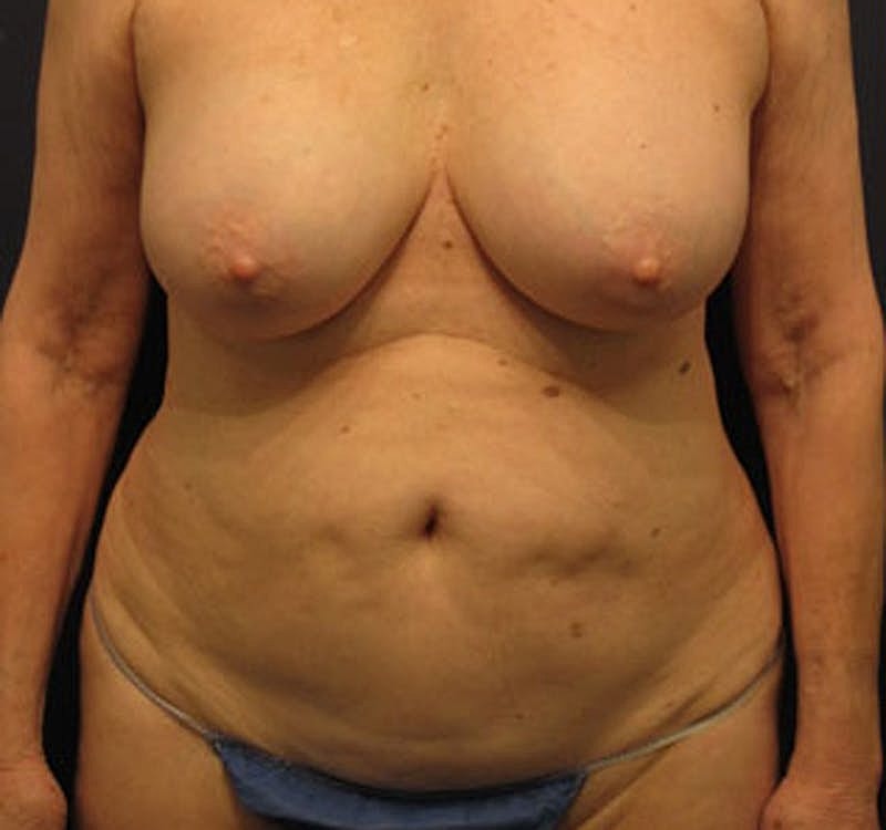 Tummy Tuck Before & After