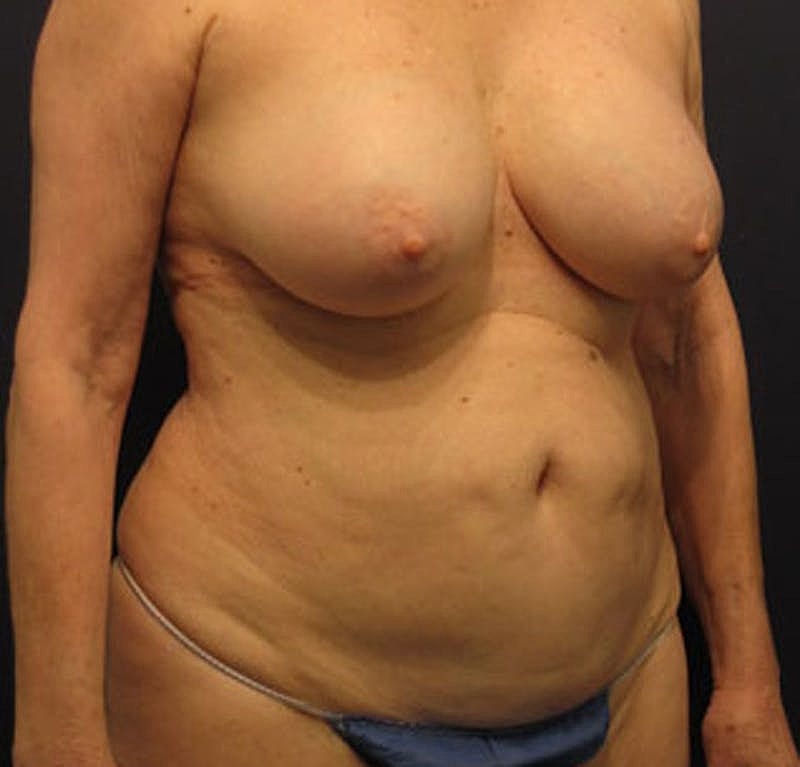 Tummy Tuck Before & After