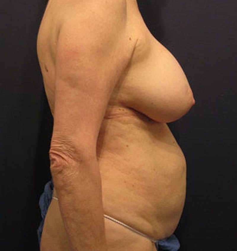 Tummy Tuck Before & After