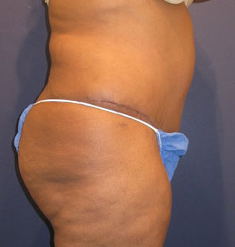 Tummy Tuck Before & After
