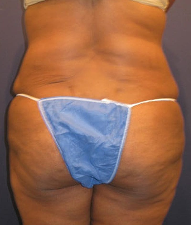 Tummy Tuck Before & After