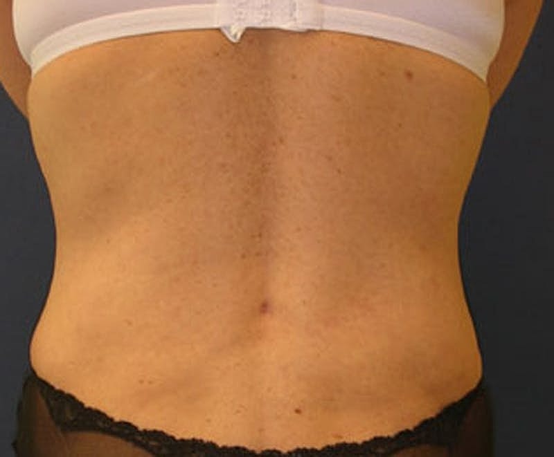 Tummy Tuck Before & After