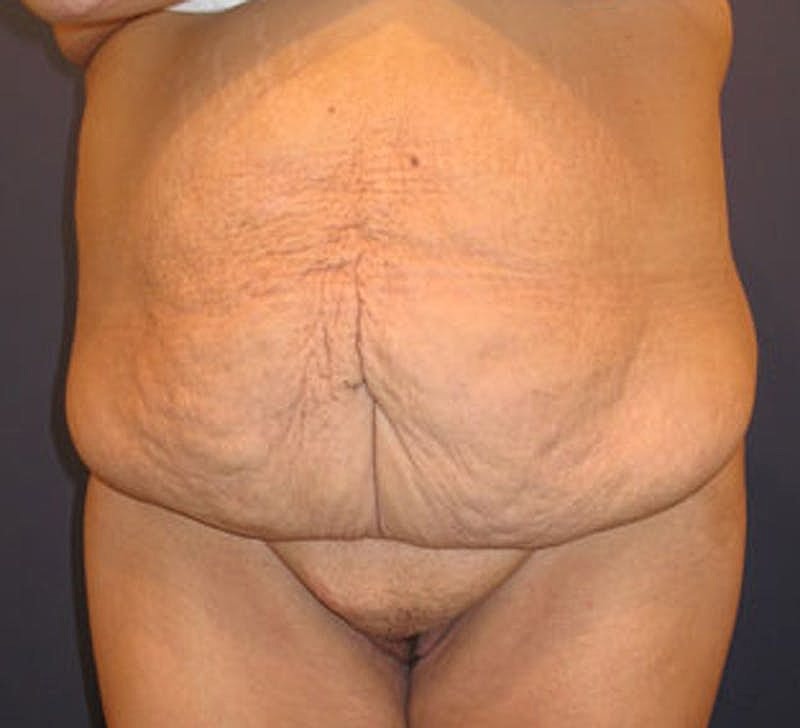 Tummy Tuck Before & After