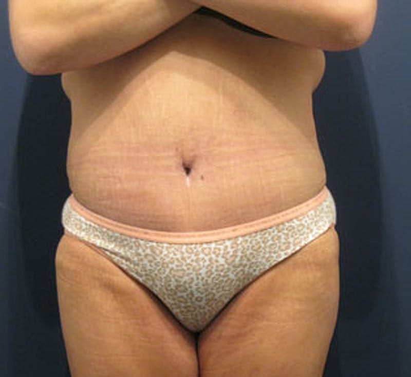 Tummy Tuck Before & After