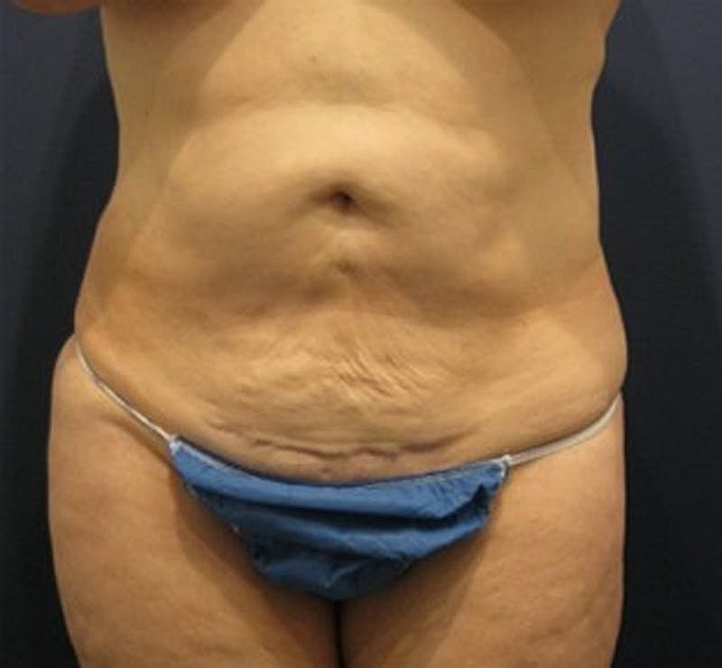 Tummy Tuck Before & After