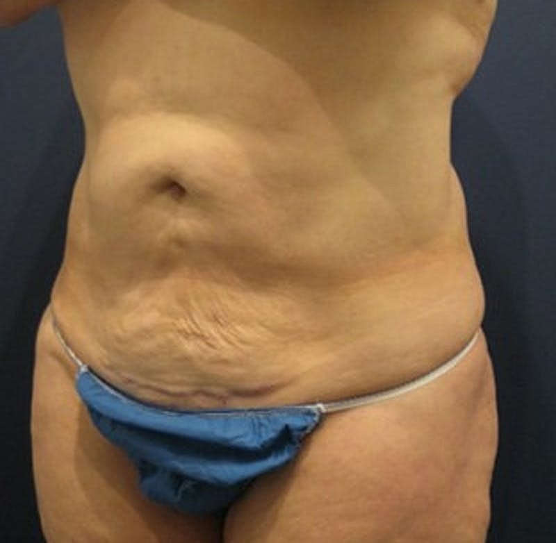 Tummy Tuck Before & After