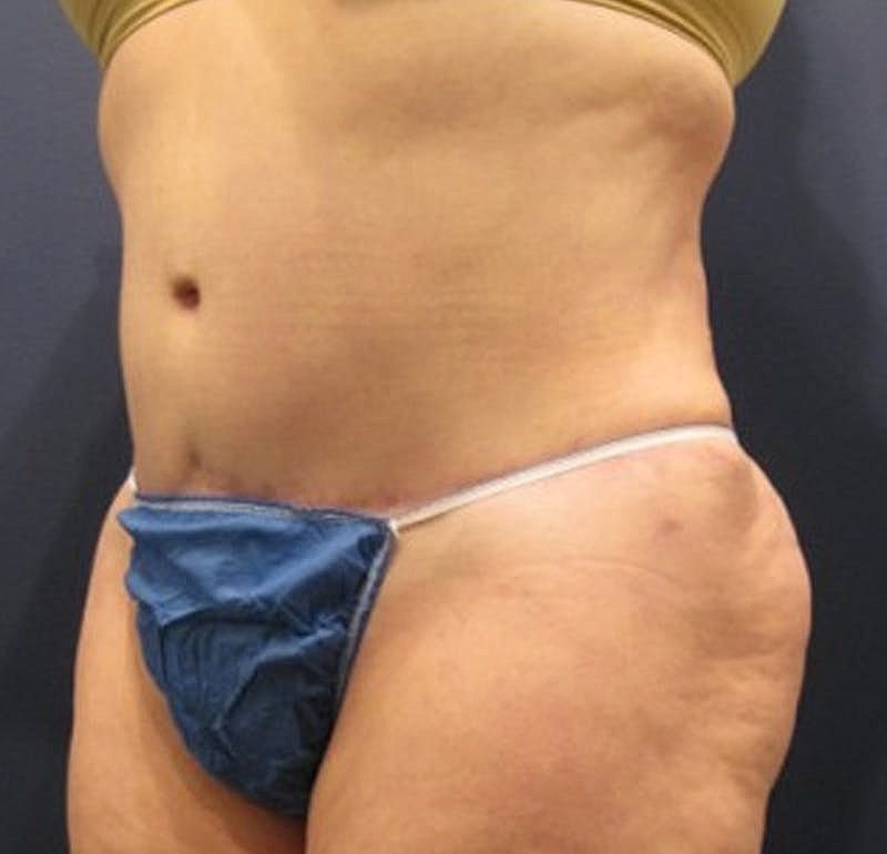 Tummy Tuck Before & After