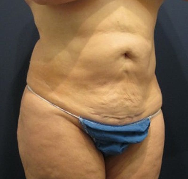 Tummy Tuck Before & After