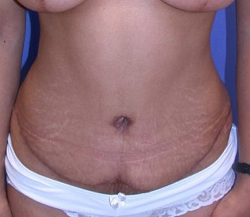 Tummy Tuck Before & After