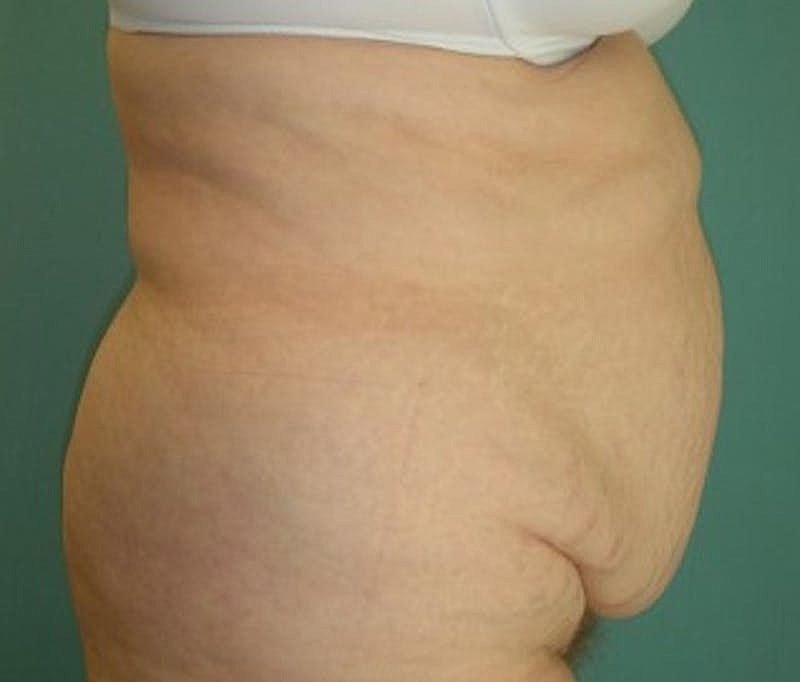 Tummy Tuck Before & After