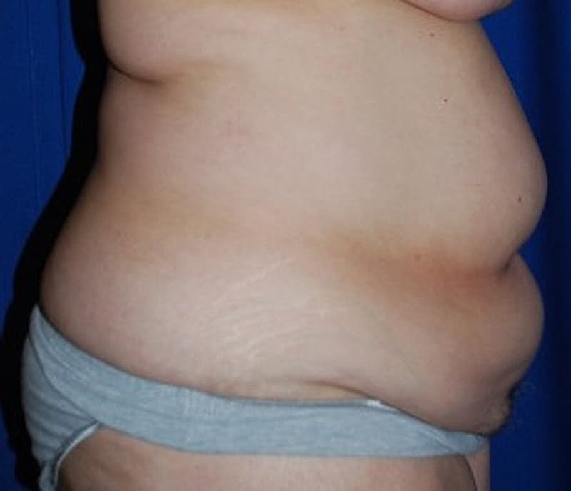 Tummy Tuck Before & After