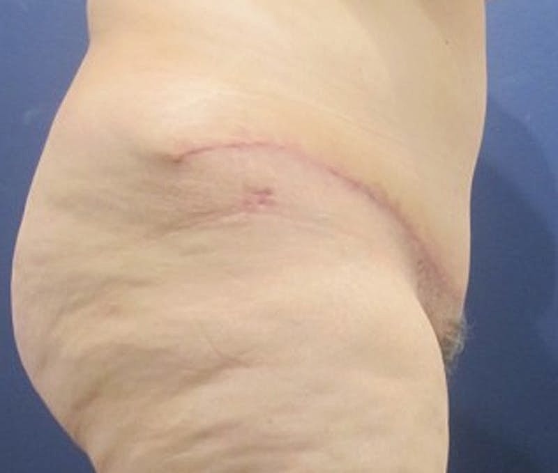 Tummy Tuck Before & After