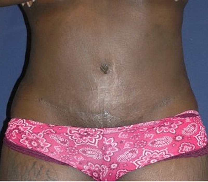 Tummy Tuck Before & After