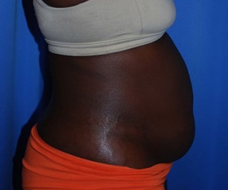 Tummy Tuck Before & After