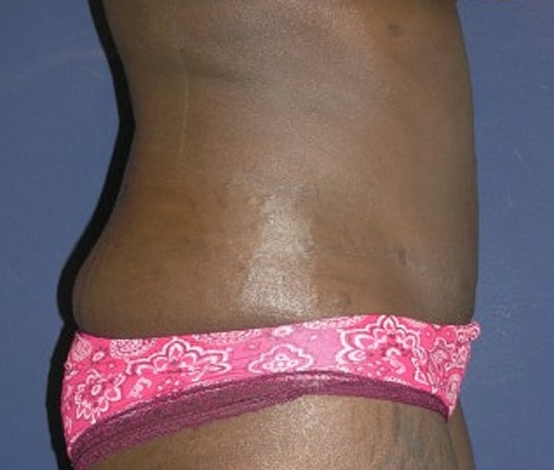 Tummy Tuck Before & After