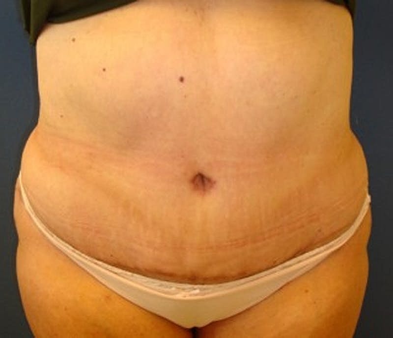 Tummy Tuck Before & After