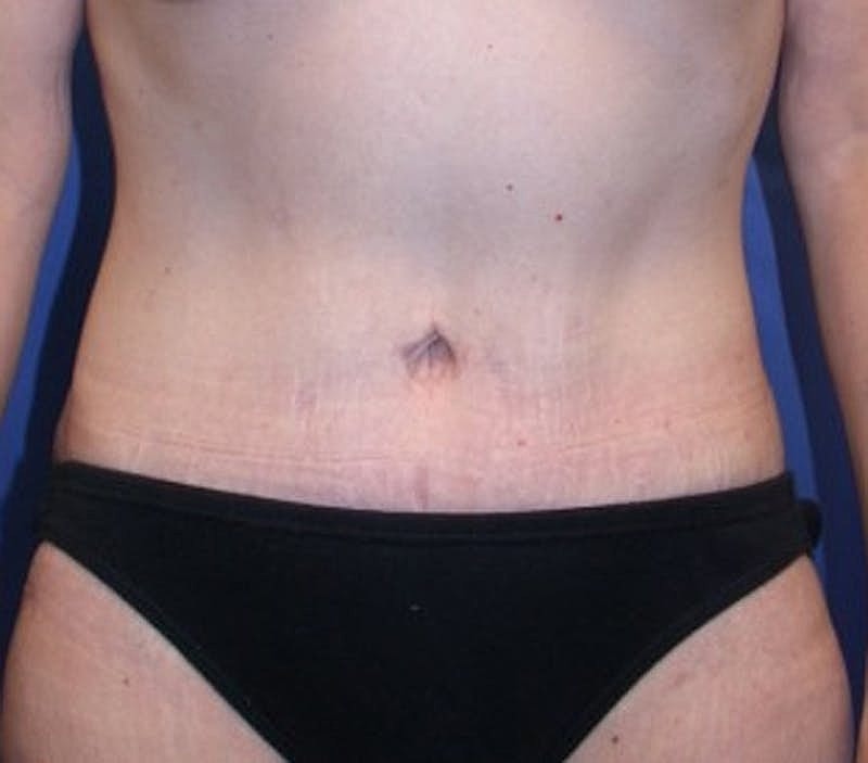 Tummy Tuck Before & After