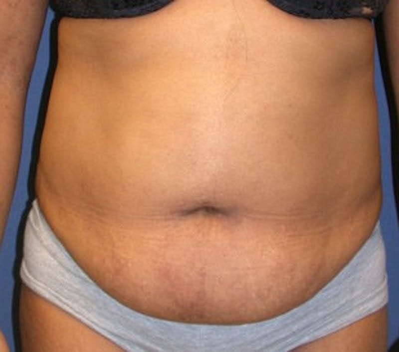 Tummy Tuck Before & After