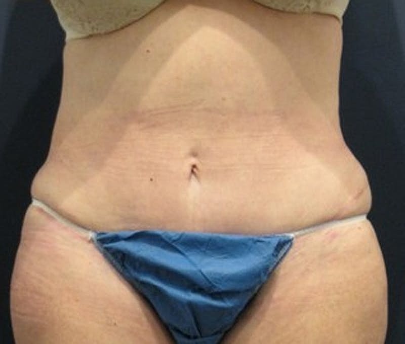 Tummy Tuck Before & After