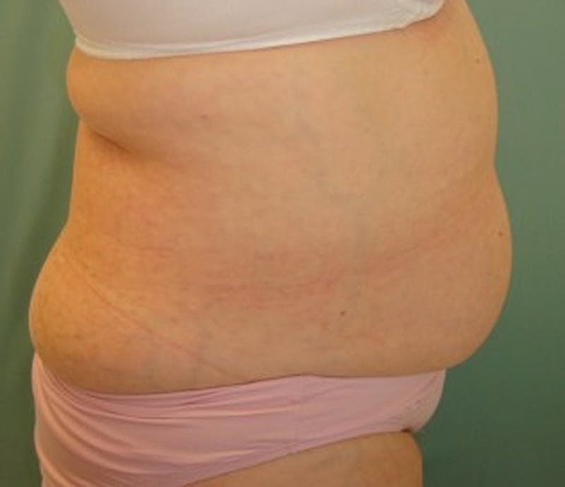 Tummy Tuck Before & After