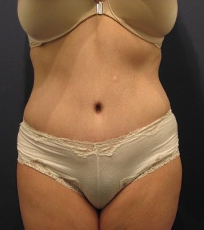 Tummy Tuck Before & After