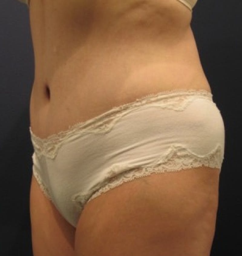 Tummy Tuck Before & After