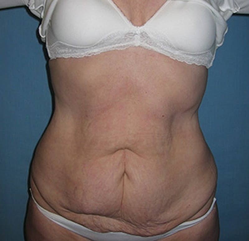Tummy Tuck Before & After