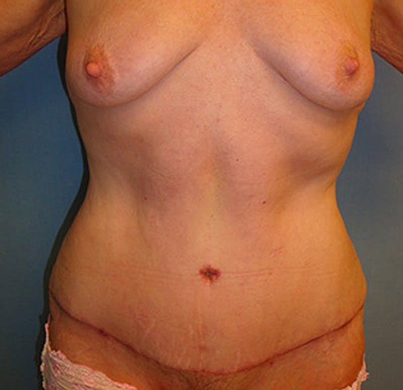 Tummy Tuck Before & After