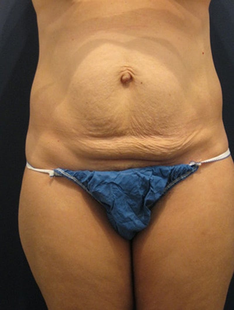 Tummy Tuck Before & After