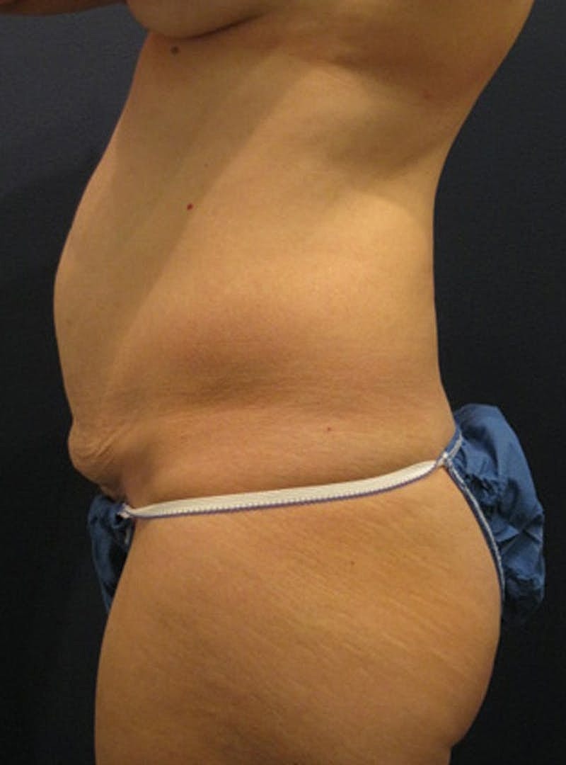 Tummy Tuck Before & After