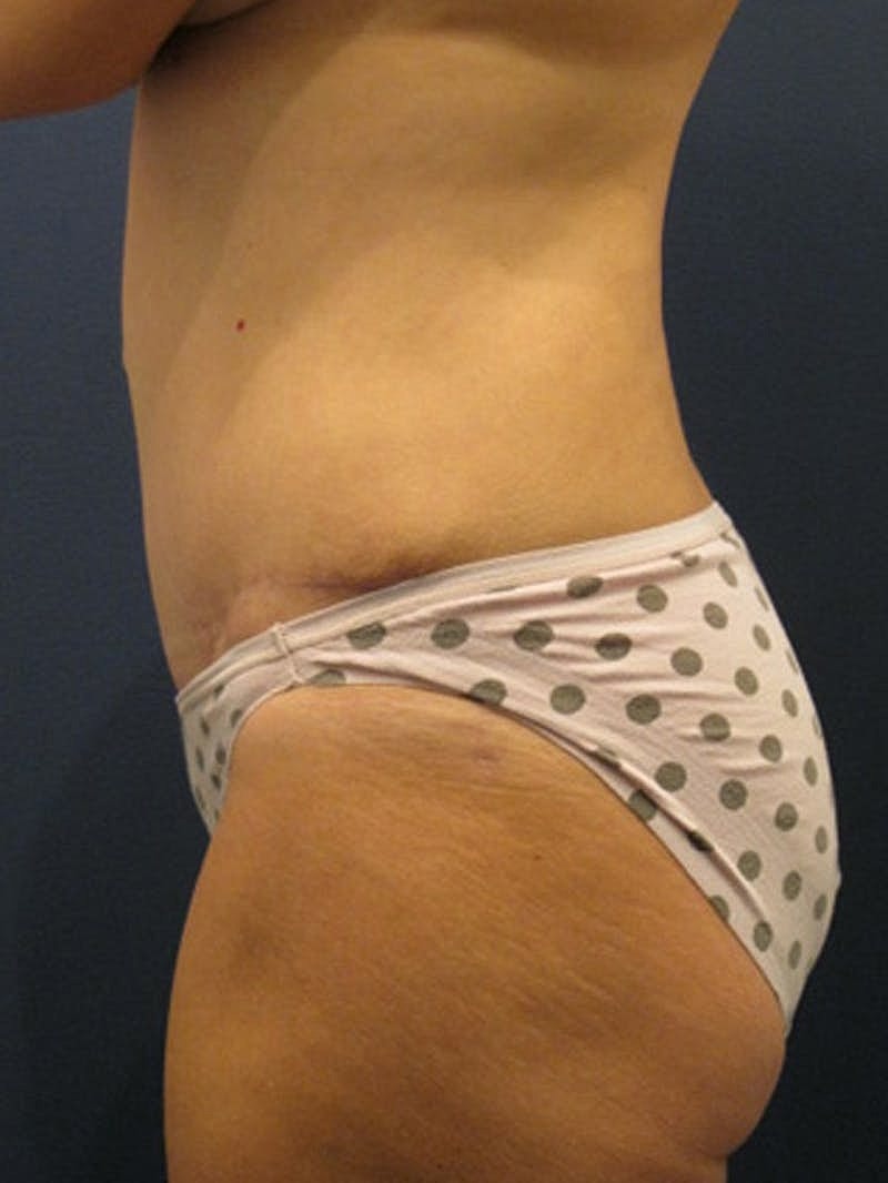 Tummy Tuck Before & After