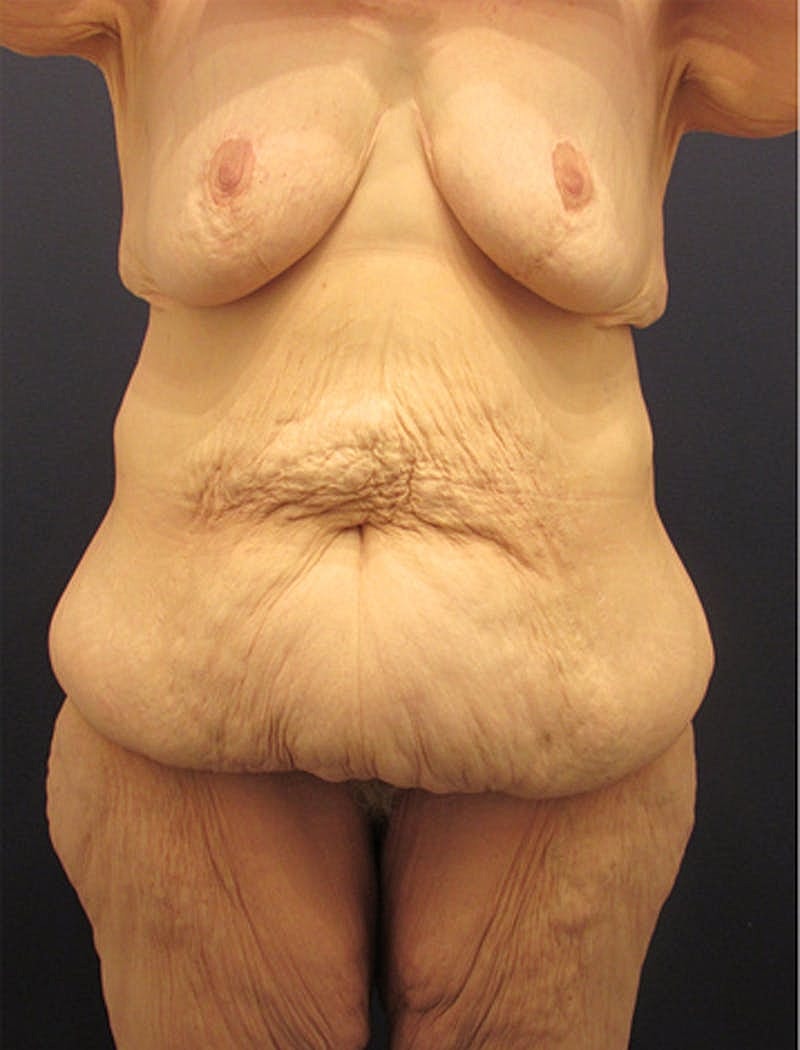 Tummy Tuck Before & After