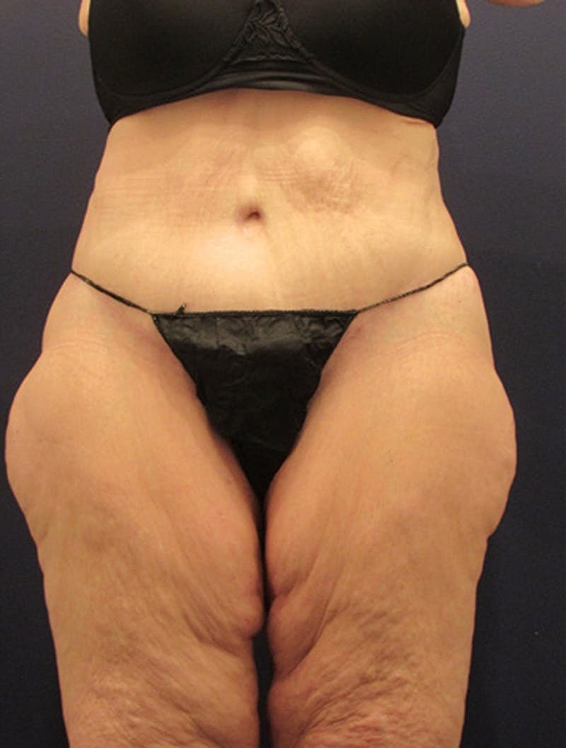 Tummy Tuck Before & After