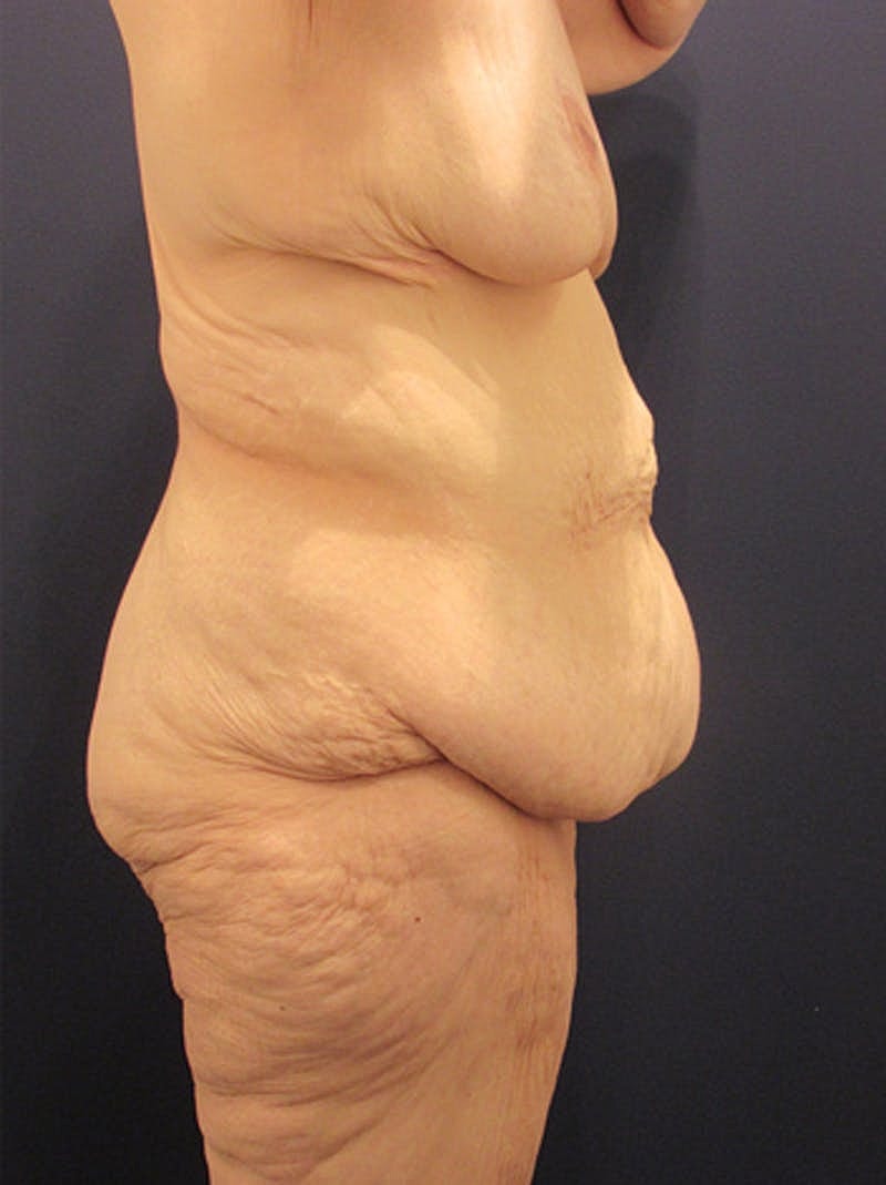 Tummy Tuck Before & After