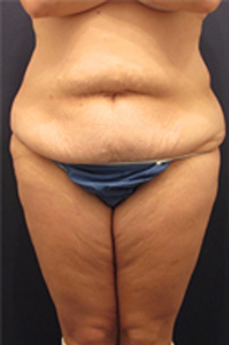 Tummy Tuck Before & After