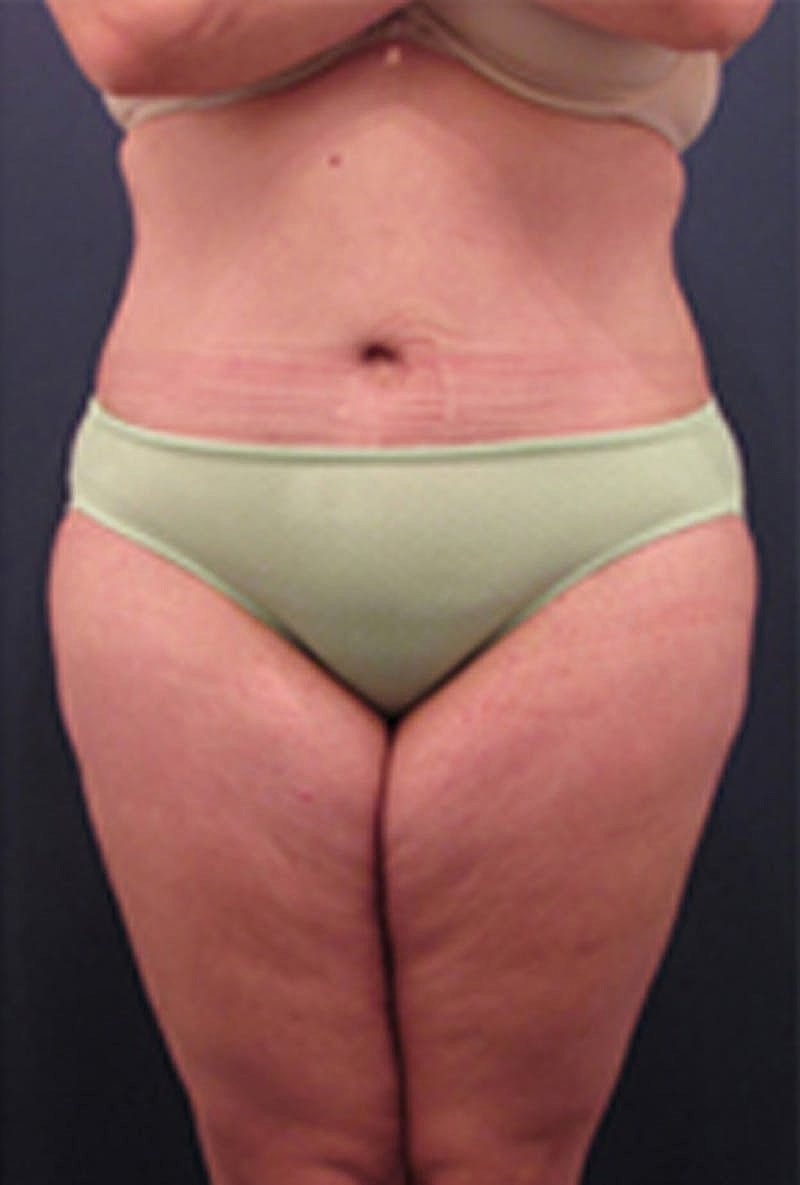 Tummy Tuck Before & After