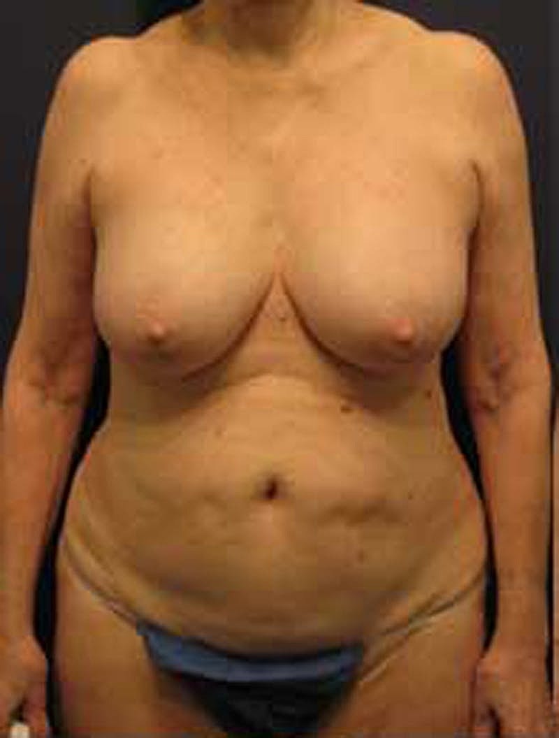Tummy Tuck Before & After