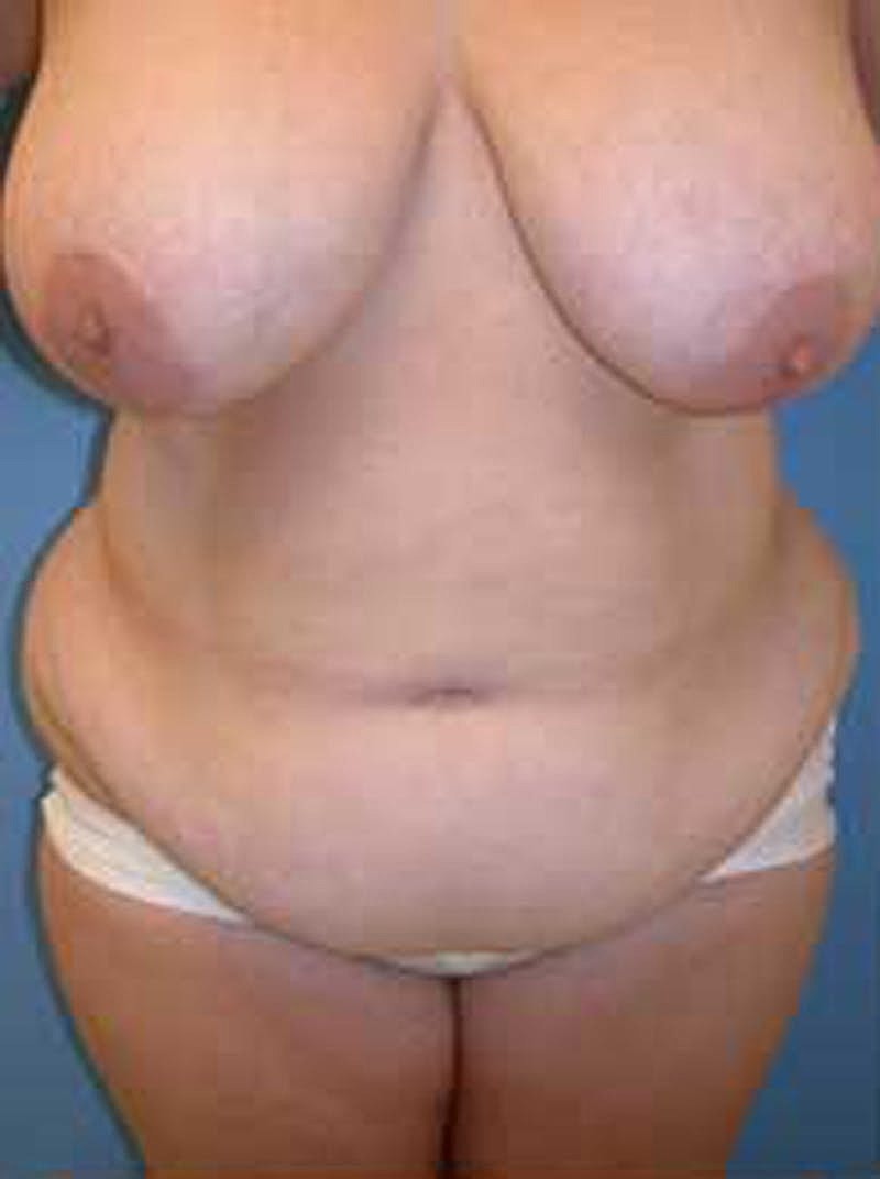 Tummy Tuck Before & After