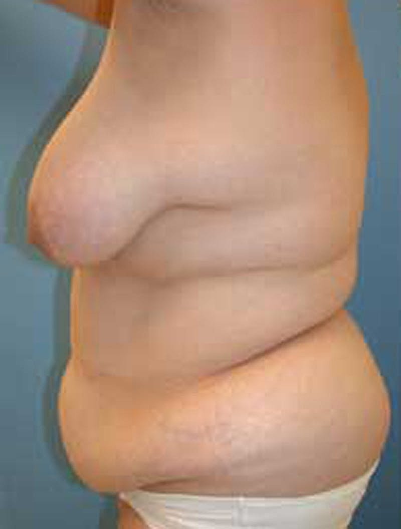 Tummy Tuck Before & After