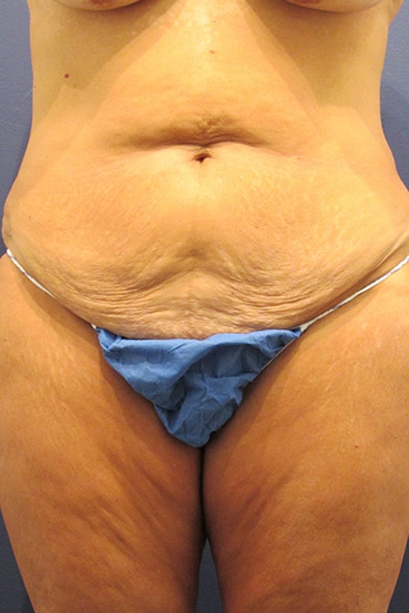 Tummy Tuck Before & After
