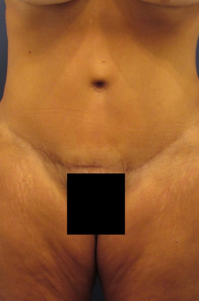 Tummy Tuck Before & After