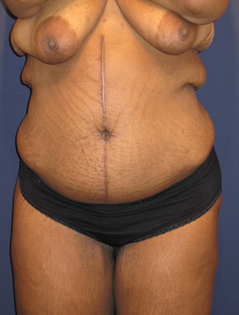 Tummy Tuck Before & After