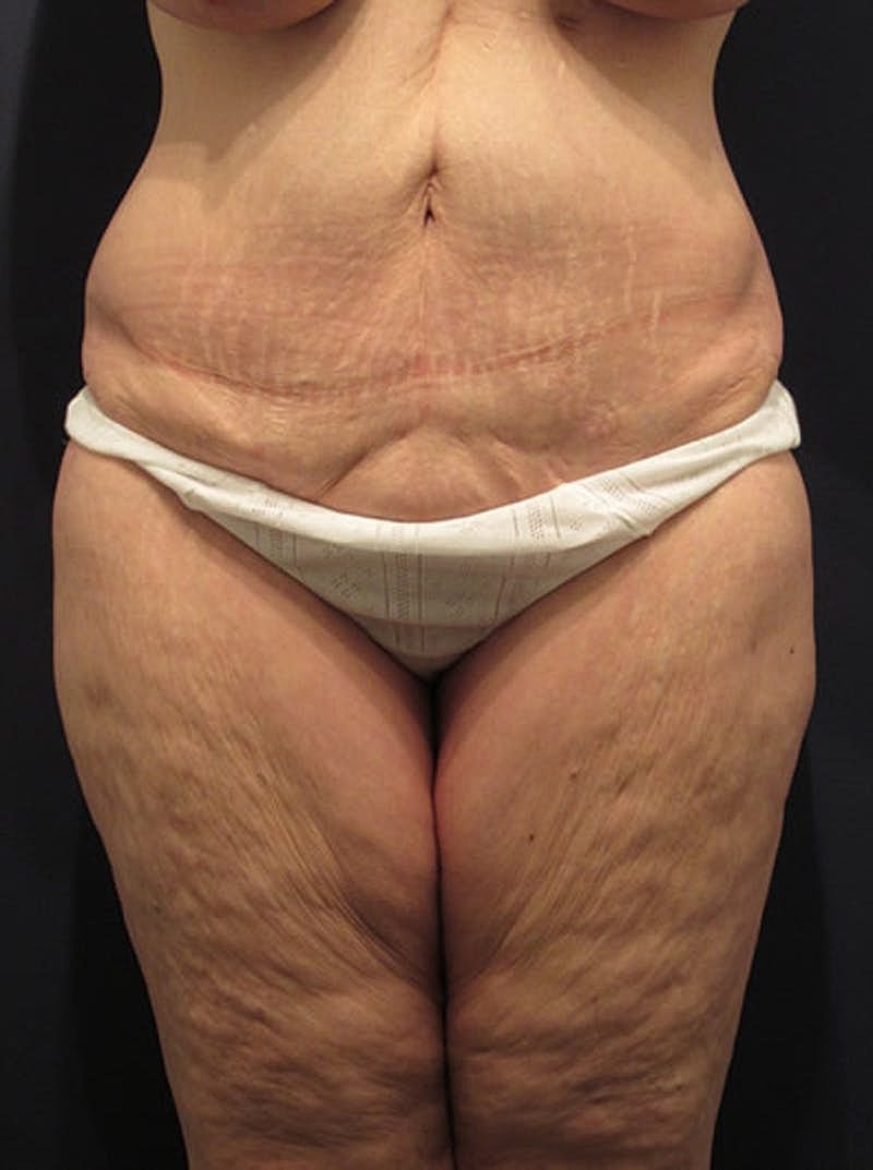 Tummy Tuck Before & After