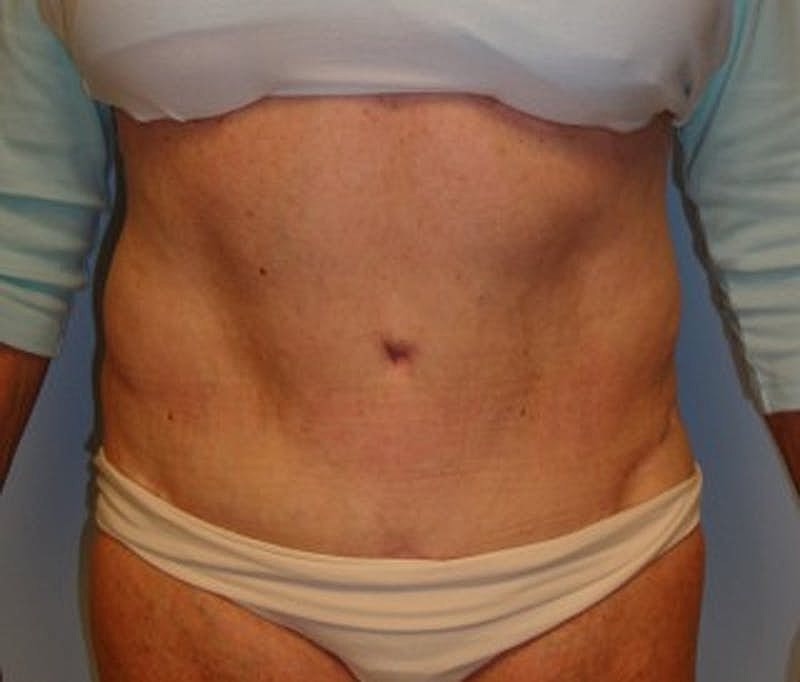 Tummy Tuck Before & After