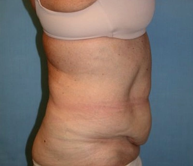 Tummy Tuck Before & After